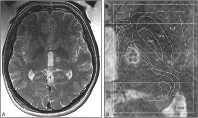 MRgFUS Pallidothalamic Tractotomy for Chronic Therapy-Resistant Parkinson's Disease in 51 Consecutive Patients: Single Center Experience